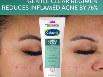 FIVE Cetaphil Acne Cleansers as low as $30.75 Shipped Free (Reg. $47.35) – FAB Ratings! | $6.15 per tube! Deep Cleans & Treats Acne Prone Skin + Save $10 when you buy $40