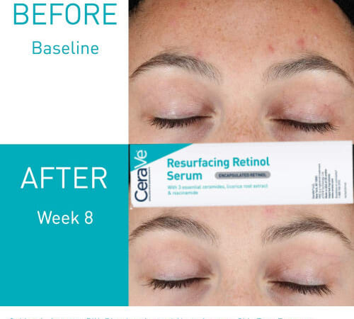 CeraVe Retinol Serum for Post-Acne Marks as low as $8.79 After Coupon (Reg. $22) + Free Shipping